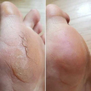 Çatlak topuk bakımı öncesi ve sonrası görünüm
